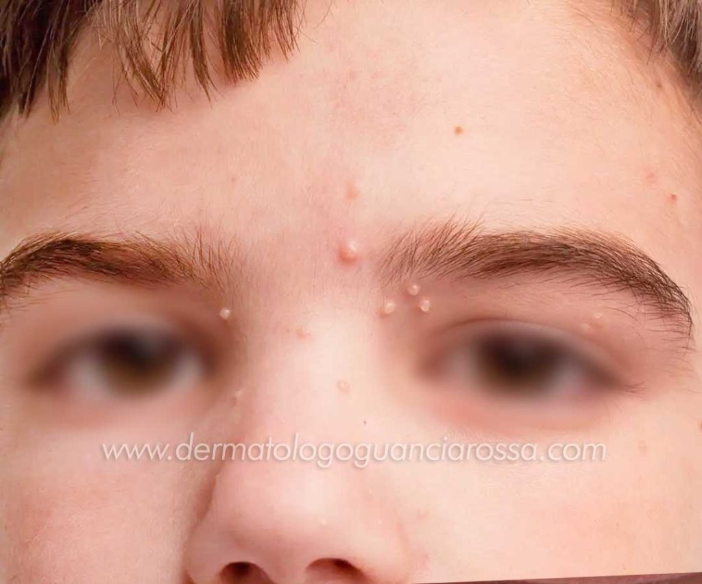 Dermatologia Pediatrica A Sant Ippolito E Fossombrone Dott Ssa