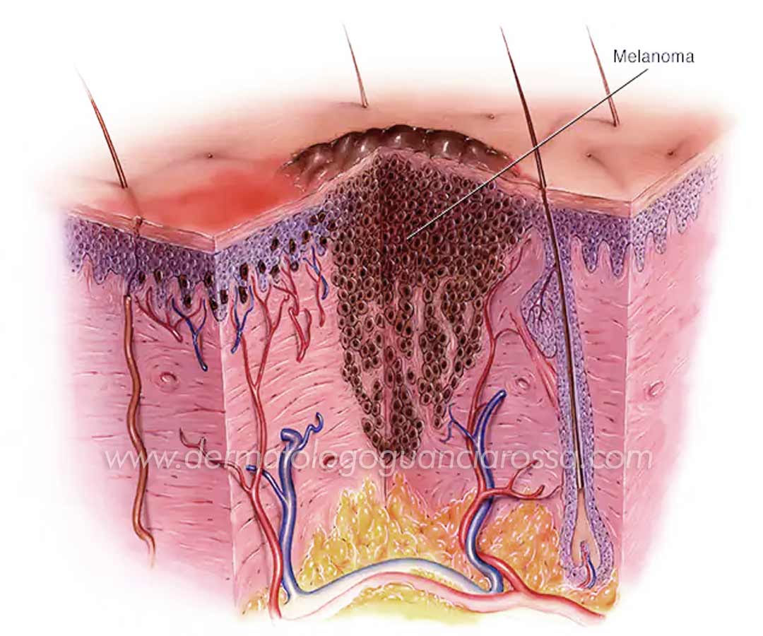 Melanoma Visita Controllo Nei Dermatologo Fossombrone Sant' Ippolito Francesca Guanciarossa