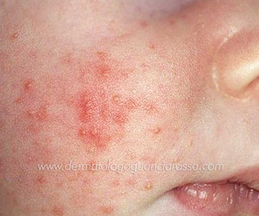 Dermatite Atopica nei Bambini - Diagnosi, Trattamento e Cura - Dermatologo a Fossombrone e Sant Ippolito, Francesca Guanciarossa