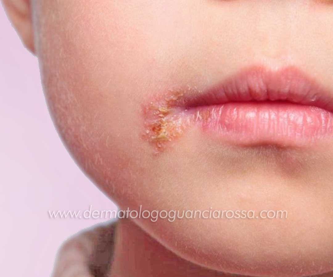 Infezioni Batteriche nei Bambini - Diagnosi, Trattamento e Cura - Dermatologo a Fossombrone e Sant Ippolito, Francesca Guanciarossa