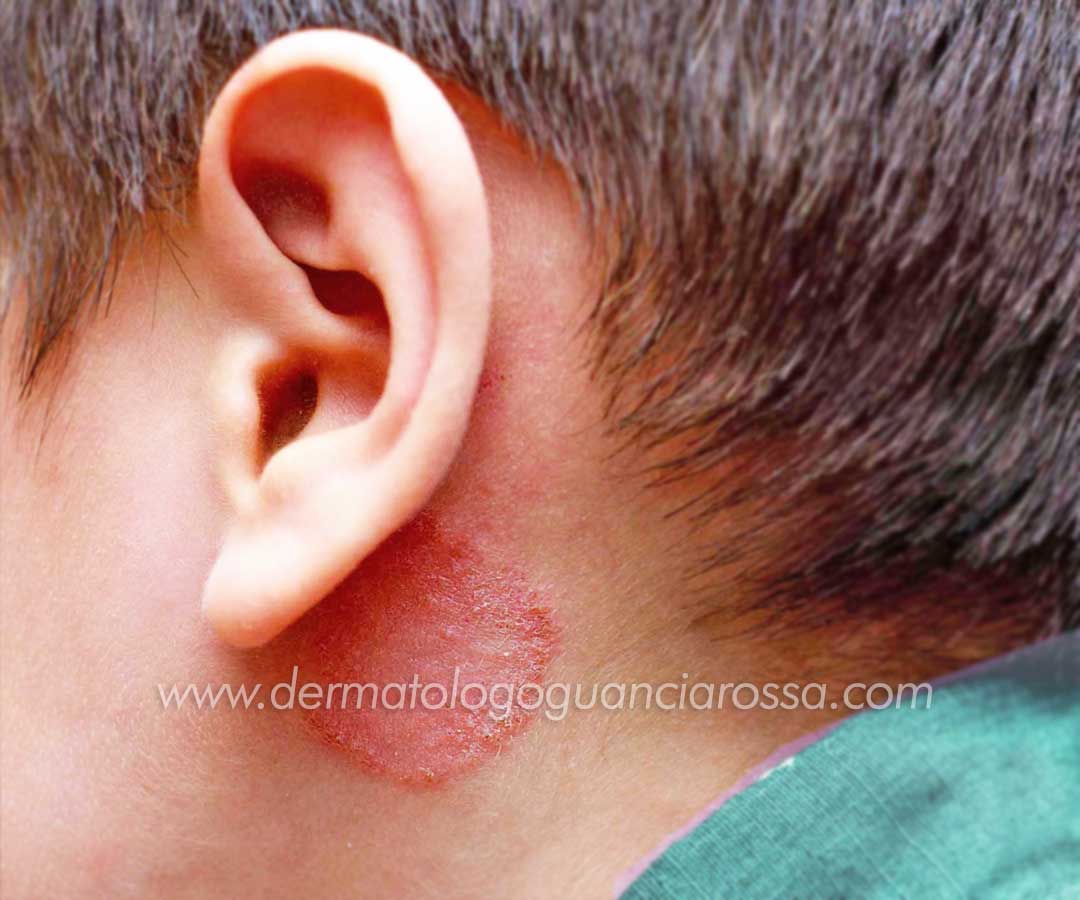 Infezioni Micotiche (funghi) nei Bambini - Diagnosi, Trattamento e Cura - Dermatologo a Fossombrone e Sant Ippolito, Francesca Guanciarossa