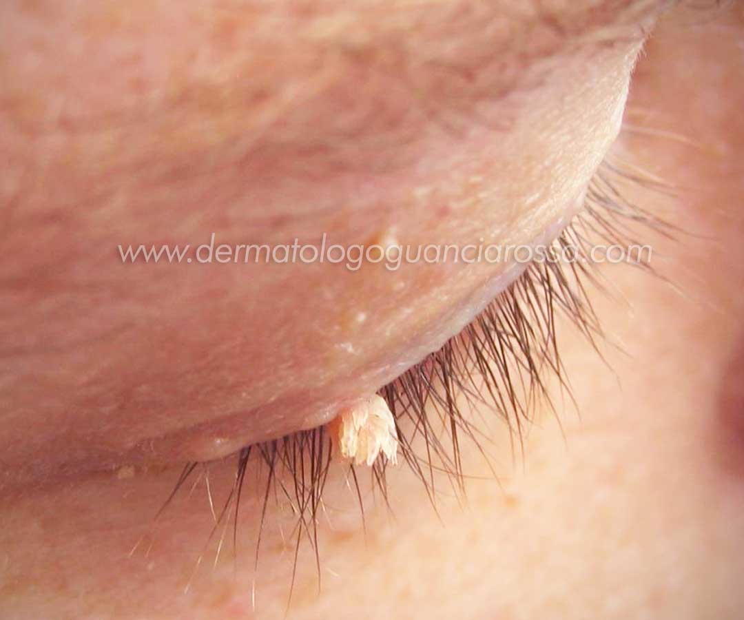 Verruche Filiformi - Trattamento, Cura e Rimozione - Dermatologo Francesca Guanciarossa : Foto Esempio delle Verruche Filiformi