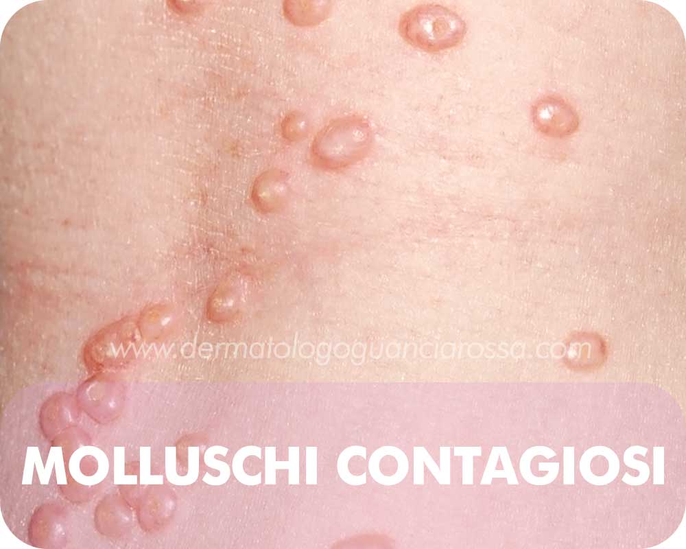 Trattamenti-Cura-Molluschi-Contagiosi-Dermatologo-Fossombrone-Sant-Ippolito-Francesca-Guanciarossa