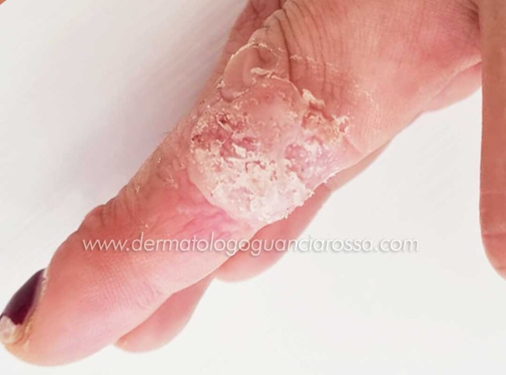 Cagli - Dermatologo Guanciarossa - Trattamento Verruca - Caso Clinico