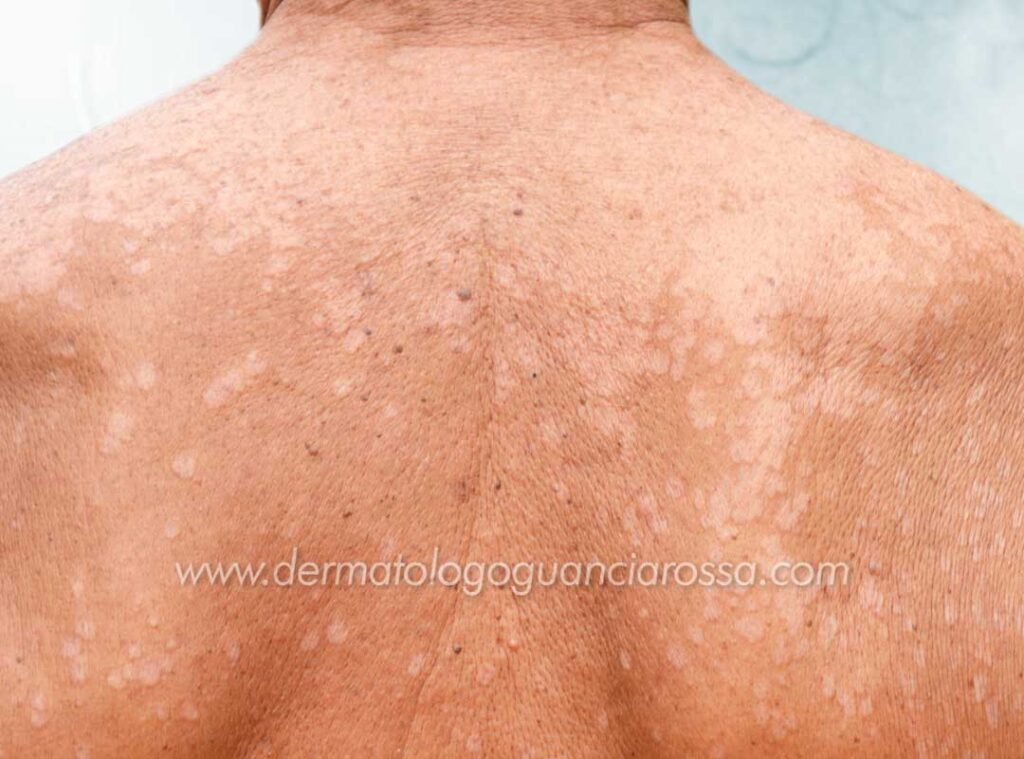 Macchie Bianche sulla Pelle - Caso Clinico - Paziente Urbino - Dermatologo Guanciarossa