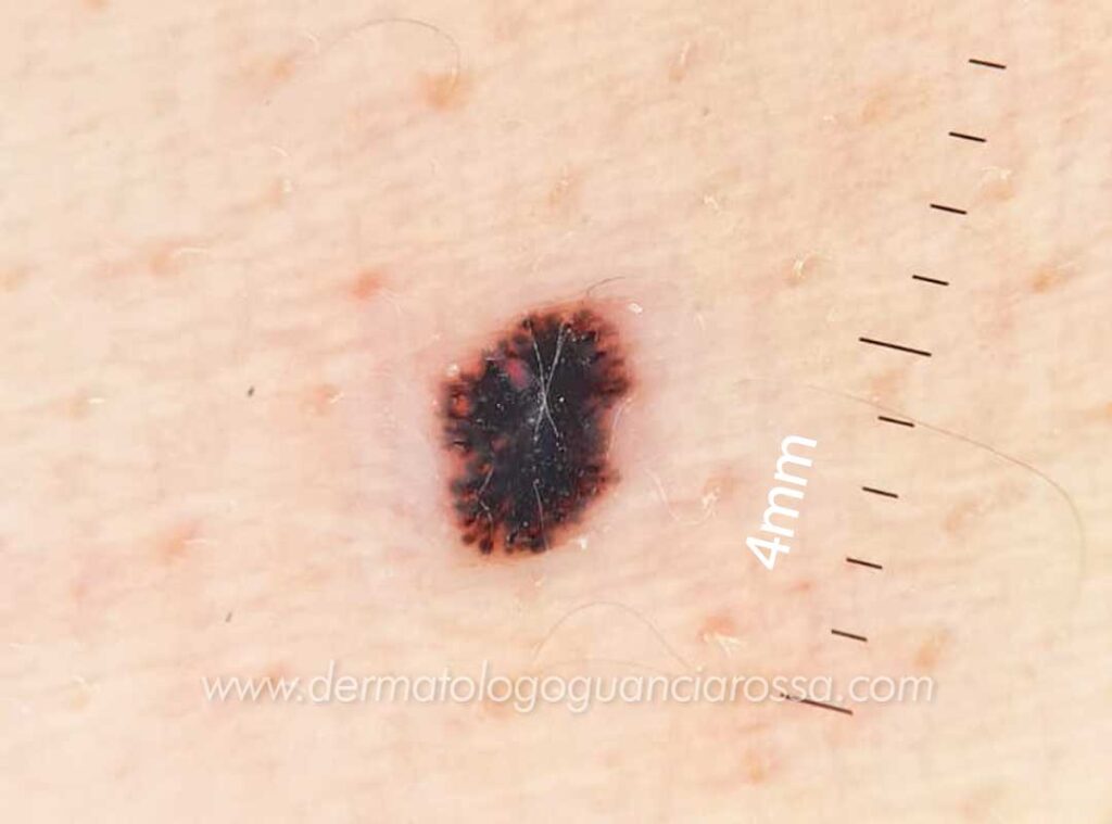 Neo Atipico - Melanoma - Caso Clinico - Paziente Calcinelli - Dermatologo Guanciarossa